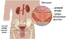 простатит простатит