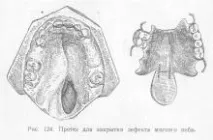 Протези (обтуратори) для закриття дефектів твердого та м’якого піднебіння, Ортопедична стоматологія обтуратори