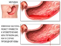 Прободна виразка шлунка симптоми та лікування (операція), причини виникнення та дієта після ушивання шлунка