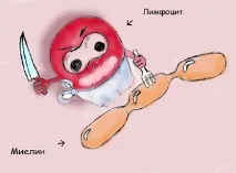 Розсіяний склероз симптоми, причини, лікування розсіяний