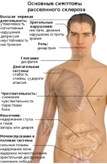 Розсіяний склероз симптоми, причини, лікування розсіяний