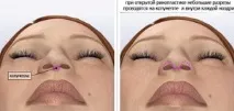 Ринопластика особливості процедури та її проведення процедури