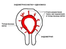 Симптоми та лікування аденоміозу симптоми