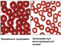 Симптоми та лікування аденоміозу аденоміозу