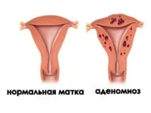 Симптоми та лікування аденоміозу матки