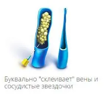 Склеротерапія в центрі флебології доктора Савінова склеротерапія