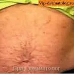 симптоми паякообразни