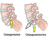 гръбначен спондилоартроза