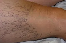 вени паякообразни