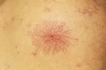 вени паякообразни