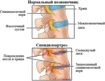 спондилоартроза стълб