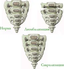 спондилоартроза спондилоартроза
