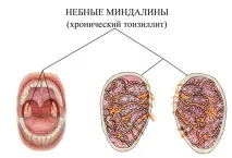 симптоми тонзилит