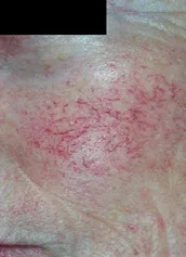 Видалення судинних зірочок, сіточки на обличчі судинних