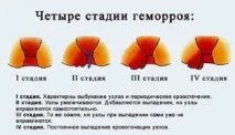 Тріщини та геморой причини, симптоми, лікування тріщини