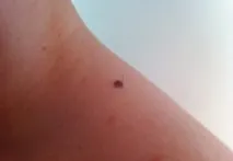 Видалення родимок зважуємо можливі наслідки видалення