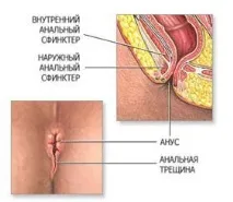 Тріщини та геморой причини, симптоми, лікування тріщини