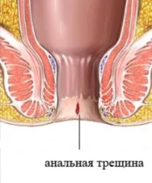 Тріщини та геморой причини, симптоми, лікування геморой