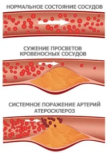 Зміцнення судин судин