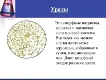 Урати в сечі у великій кількості що це означає сечі