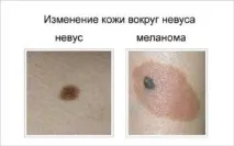 Види меланом та їх лікування меланом