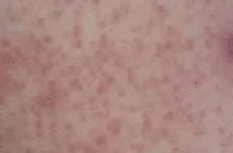 захворювання