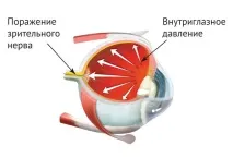 АІЛАЗ Глаукома - родичка - Паркінсона та Альцгеймера родичка