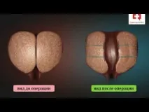 простатата степен