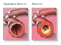 симптоми бронхит
