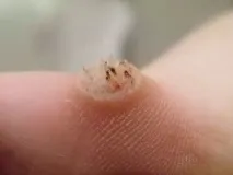 лечение брадавици