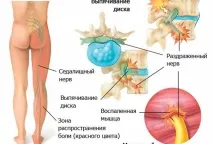 възпаление седалищния седалищния нерв