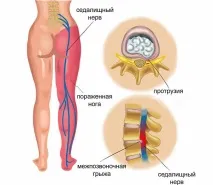 ишиас възпаление седалищния