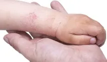 ексфоліативний