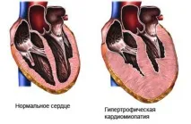 хипертрофия хипертрофия