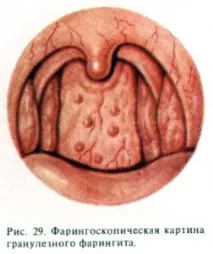 Гранулозний фарингіт симптоми та лікування гранулозний