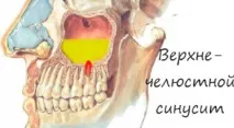 Як діагностувати та лікувати верхньощелепний синусит верхньощелепний