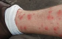 генитални отървем