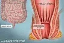 проктологично лечение