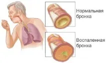 Як приймати еуфілін при бронхіті дітям та дорослим приймати
