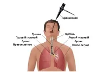Як проводиться бронхоскопія бронхоскопія