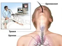 Як проводиться бронхоскопія бронхоскопія