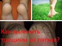 Як вилікувати тріщини на п’ятах тріщини