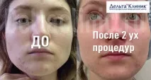 лечение акне лечение