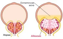 лечение аденом
