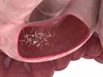 giardiasis заболяване