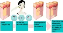 Мезотерапія від прищів відгуки, переваги, протипоказання, фото до та після мезотерапія