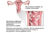 Народні засоби від молочниці при вагітності засоби
