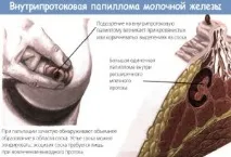 Папіломи на сосках при вагітності | сосках