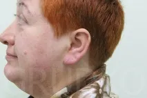 Пластика мочок вух, відновлення розірваної мочки вуха, як зменшити дірки у вухах, як вуха