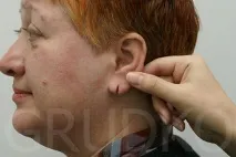 Пластика мочок вух, відновлення розірваної мочки вуха, як зменшити дірки у вухах, як пластика